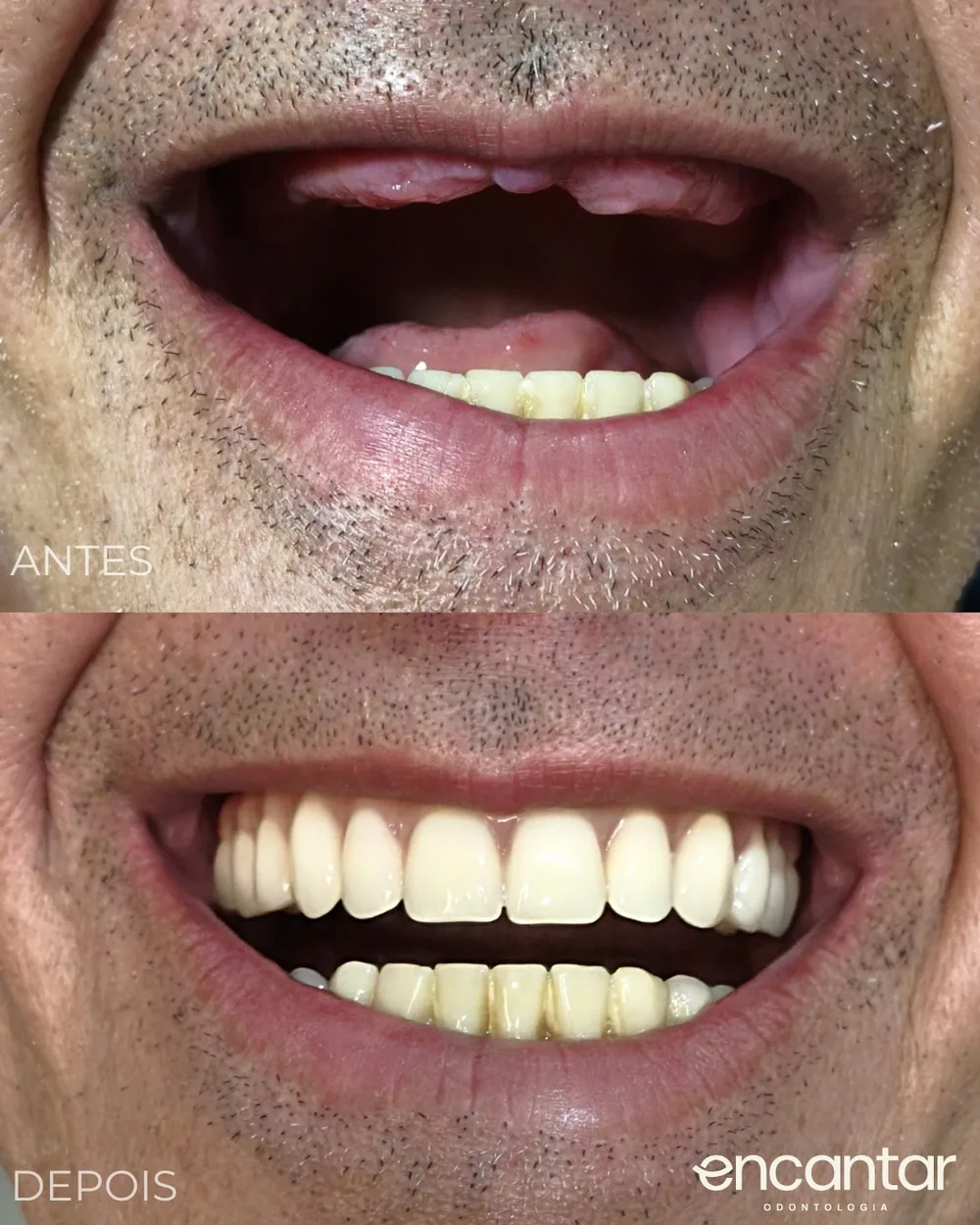 Antes e depois de um protocolo fixo na Encantar Odontologia